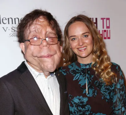 Adam Pearson's Wife Untold Stories and an Inspiring Journey